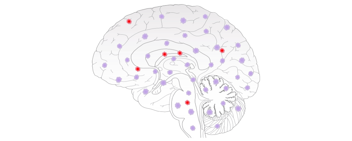 Schematic of a human brain featuring purple (healthy) and red (mutated) microglia cells